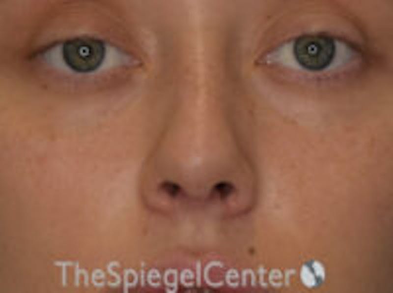 Rhinoplasty Before & After Gallery - Patient 132262 - Image 4