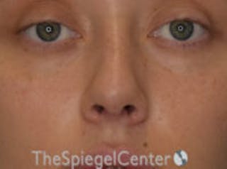 Rhinoplasty Before & After Gallery - Patient 132262 - Image 4