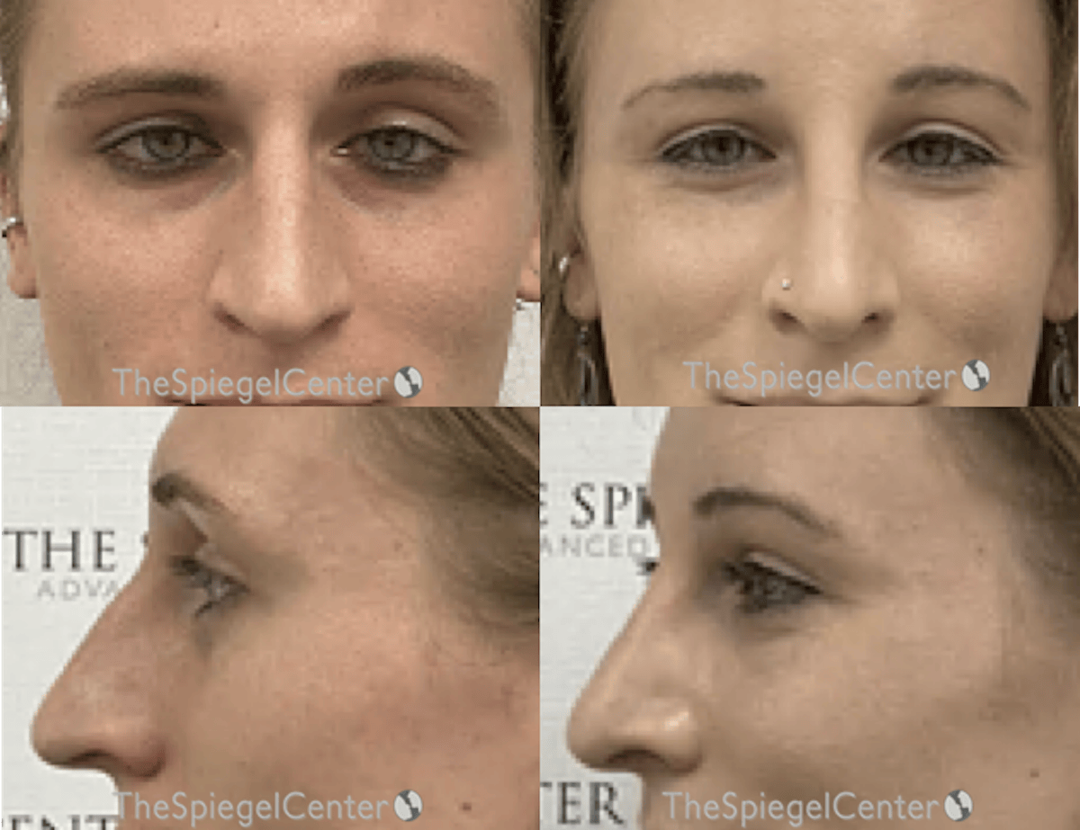 Rhinoplasty Before & After Gallery - Patient 332371 - Image 1