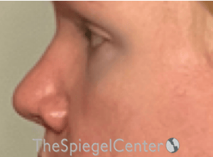 Rhinoplasty Before & After Gallery - Patient 287243 - Image 1