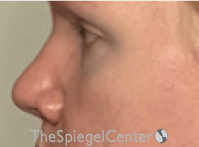 Rhinoplasty Before & After Gallery - Patient 287243 - Image 1