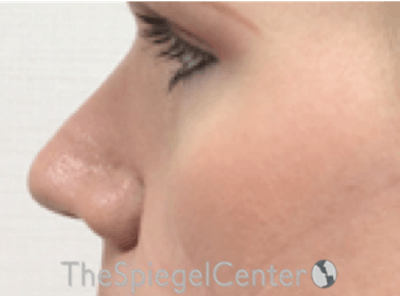 Rhinoplasty Before & After Gallery - Patient 287243 - Image 2