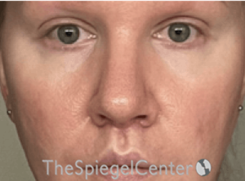 Rhinoplasty Before & After Gallery - Patient 287243 - Image 3