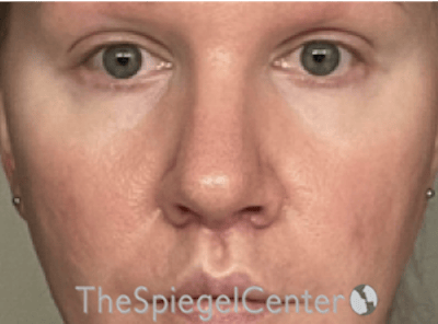 Rhinoplasty Before & After Gallery - Patient 287243 - Image 3