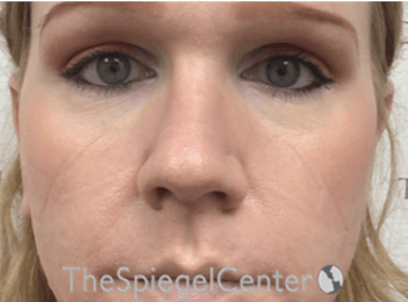 Rhinoplasty Before & After Gallery - Patient 287243 - Image 4