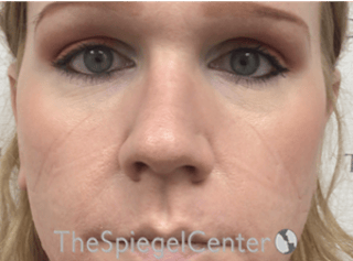 Rhinoplasty Before & After Gallery - Patient 287243 - Image 4