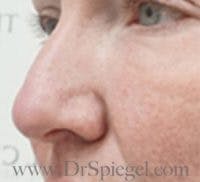 Rhinoplasty Before & After Gallery - Patient 279177 - Image 1