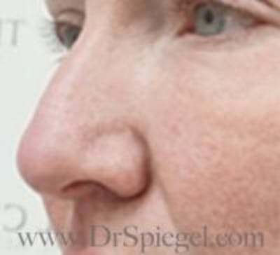 Rhinoplasty Before & After Gallery - Patient 279177 - Image 1