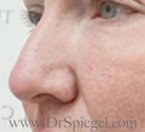 Rhinoplasty Before & After Gallery - Patient 279177 - Image 1
