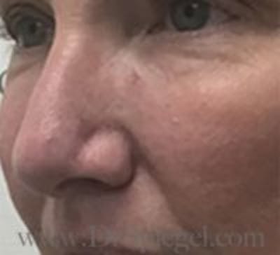 Rhinoplasty Before & After Gallery - Patient 279177 - Image 2