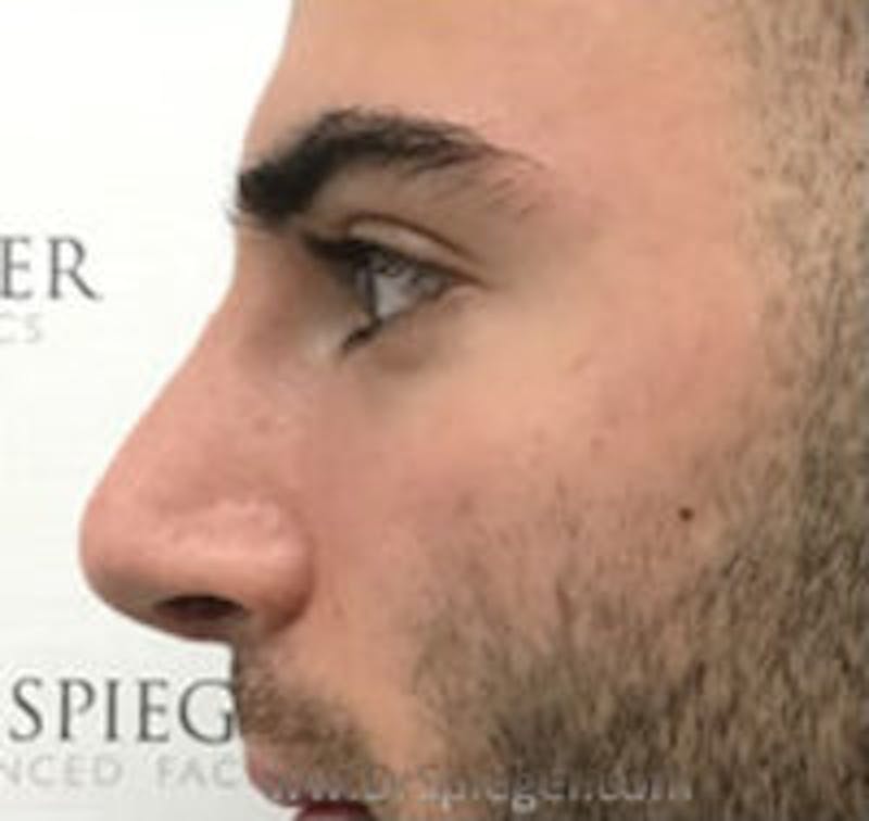 Rhinoplasty Before & After Gallery - Patient 318096 - Image 2