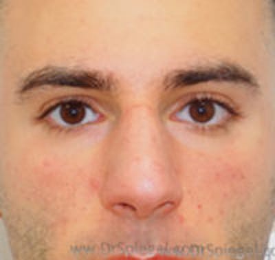 Rhinoplasty Before & After Gallery - Patient 318096 - Image 3