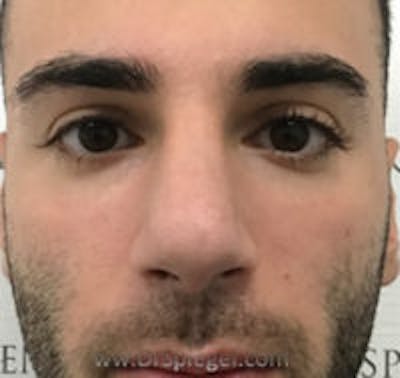 Rhinoplasty Before & After Gallery - Patient 318096 - Image 4