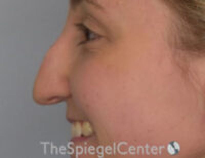 Rhinoplasty Before & After Gallery - Patient 300053 - Image 1