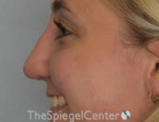 Rhinoplasty Before & After Gallery - Patient 300053 - Image 2