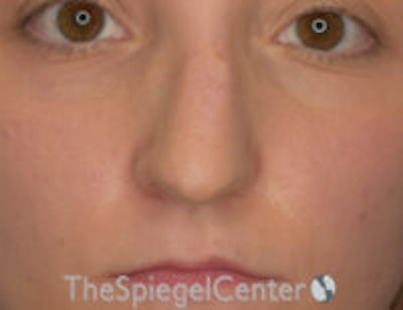 Rhinoplasty Before & After Gallery - Patient 300053 - Image 3