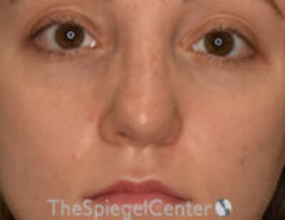 Rhinoplasty Before & After Gallery - Patient 300053 - Image 4