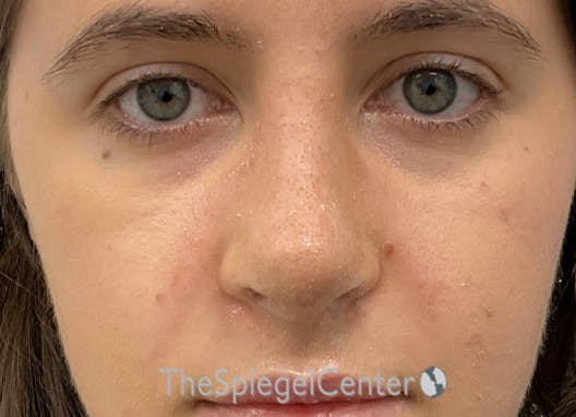 Rhinoplasty Before & After Gallery - Patient 260560 - Image 4