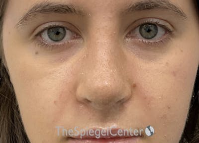 Rhinoplasty Before & After Gallery - Patient 260560 - Image 4