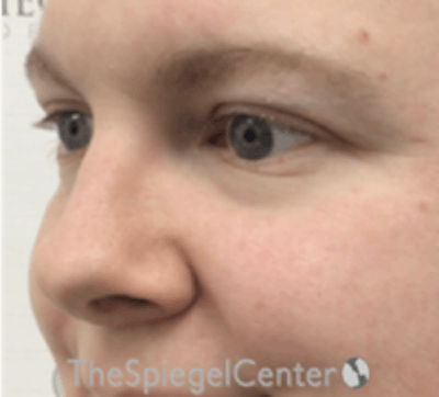 Rhinoplasty Before & After Gallery - Patient 168077 - Image 1