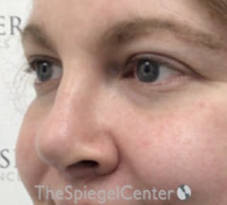 Rhinoplasty Before & After Gallery - Patient 168077 - Image 2