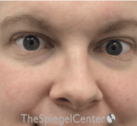 Rhinoplasty Before & After Gallery - Patient 168077 - Image 3