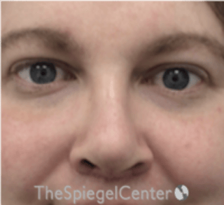 Rhinoplasty Before & After Gallery - Patient 168077 - Image 4