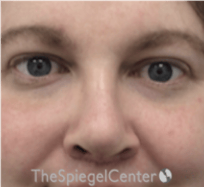 Rhinoplasty Before & After Gallery - Patient 168077 - Image 4