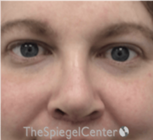 Rhinoplasty Before & After Gallery - Patient 168077 - Image 4