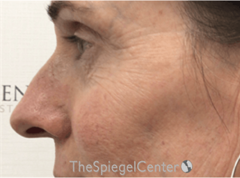 Rhinoplasty Before & After Gallery - Patient 588377 - Image 1