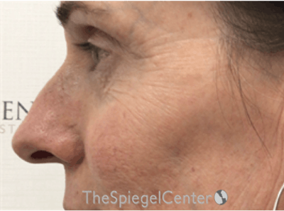 Rhinoplasty Before & After Gallery - Patient 588377 - Image 1