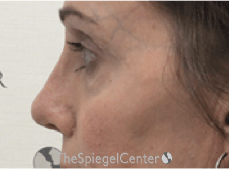 Rhinoplasty Before & After Gallery - Patient 588377 - Image 2