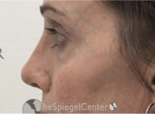 Rhinoplasty Before & After Gallery - Patient 588377 - Image 2
