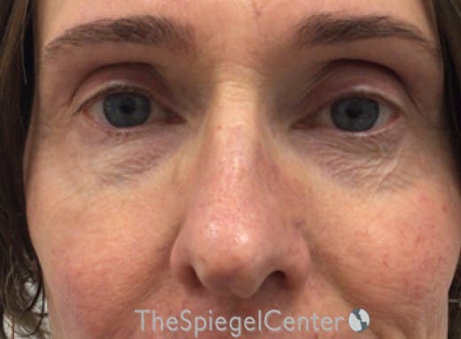 Rhinoplasty Before & After Gallery - Patient 588377 - Image 3