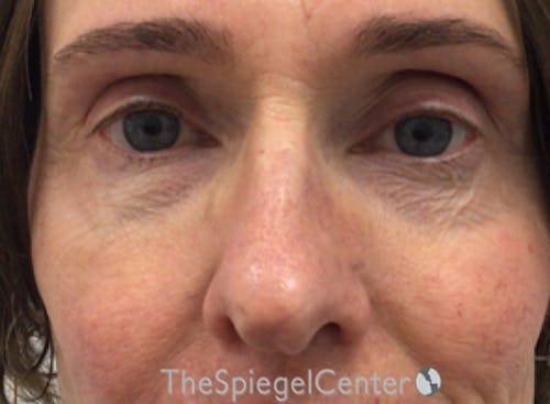 Rhinoplasty Before & After Gallery - Patient 588377 - Image 3