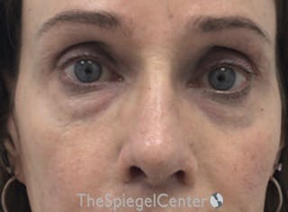 Rhinoplasty Before & After Gallery - Patient 588377 - Image 4