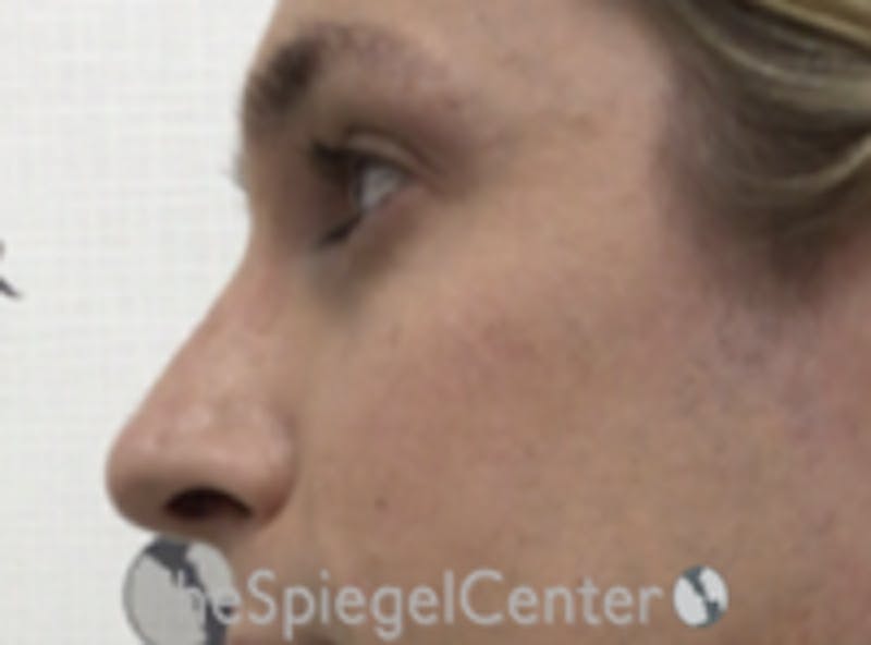Rhinoplasty Before & After Gallery - Patient 395818 - Image 1
