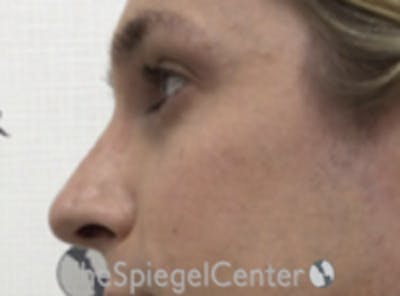 Rhinoplasty Before & After Gallery - Patient 395818 - Image 1