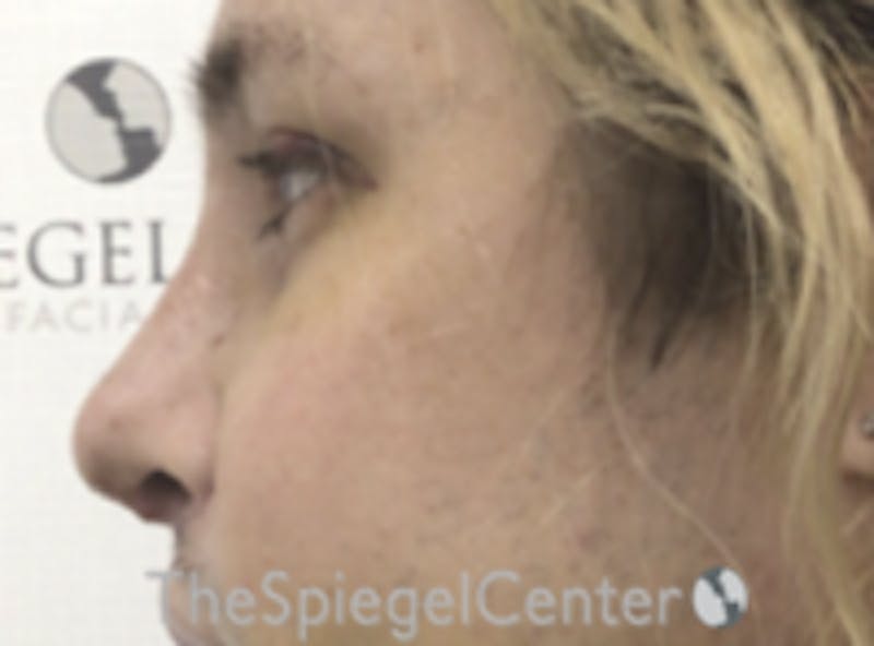 Rhinoplasty Before & After Gallery - Patient 395818 - Image 2
