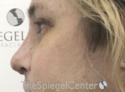 Rhinoplasty Before & After Gallery - Patient 395818 - Image 2