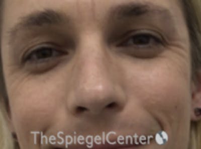 Rhinoplasty Before & After Gallery - Patient 395818 - Image 3