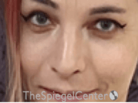 Rhinoplasty Before & After Gallery - Patient 395818 - Image 4
