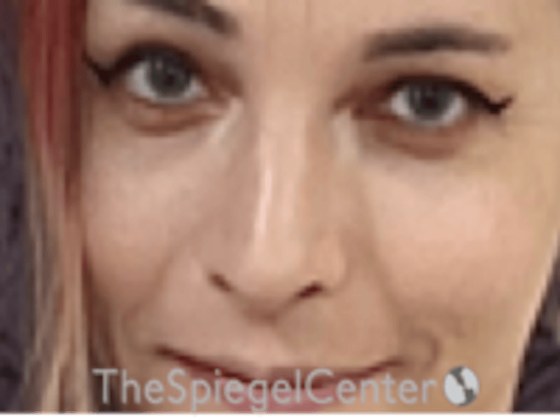 Rhinoplasty Before & After Gallery - Patient 395818 - Image 4