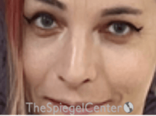 Rhinoplasty Before & After Gallery - Patient 395818 - Image 4