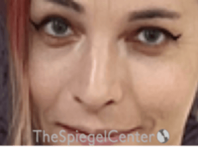 Rhinoplasty Before & After Gallery - Patient 395818 - Image 4