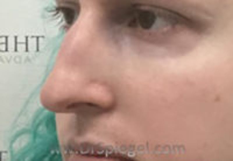 Rhinoplasty Before & After Gallery - Patient 104077 - Image 1