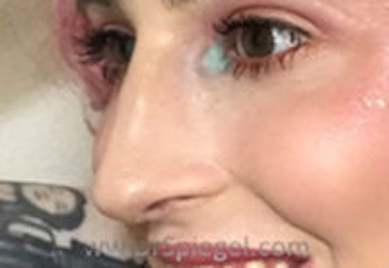 Rhinoplasty Before & After Gallery - Patient 104077 - Image 2