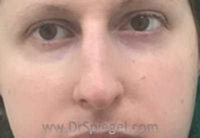 Rhinoplasty Before & After Gallery - Patient 104077 - Image 3