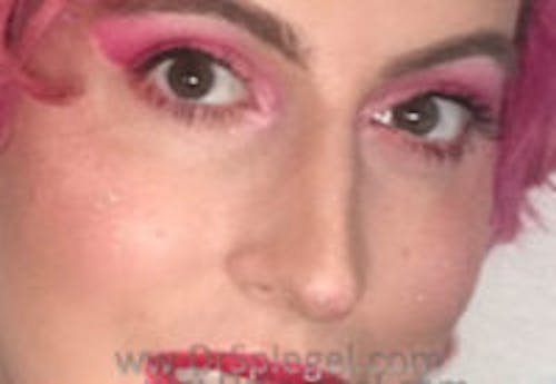 Rhinoplasty Before & After Gallery - Patient 104077 - Image 4