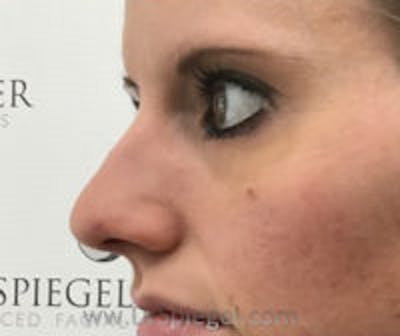 Rhinoplasty Before & After Gallery - Patient 367086 - Image 1